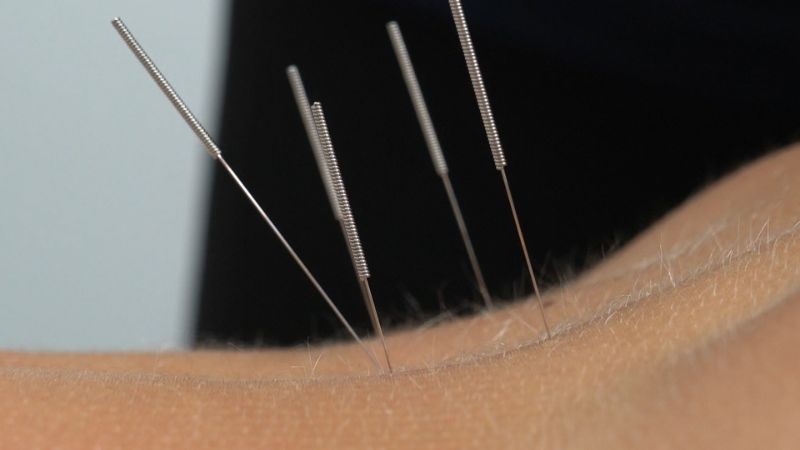 accupunture for sciatica treatment